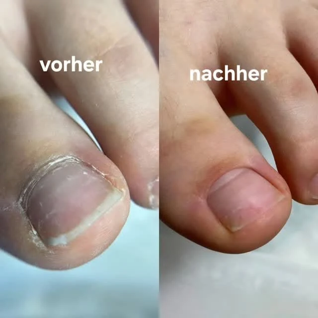 Großzehennagel vorher verdickt und nachher glatt gepflegt